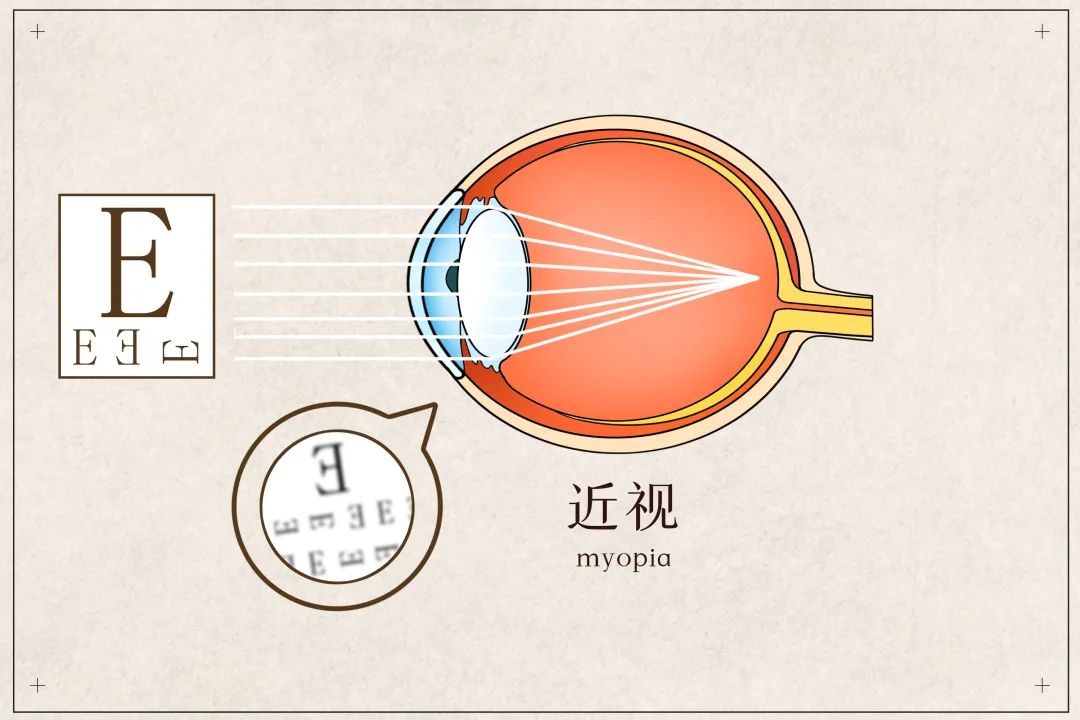 周口近视眼矫正需要做手术吗？
